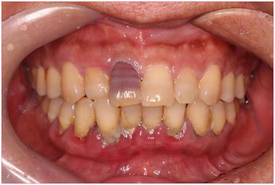 Unveiling the dark side of Prevotella: a case of fatal pneumonia from a common probiotic